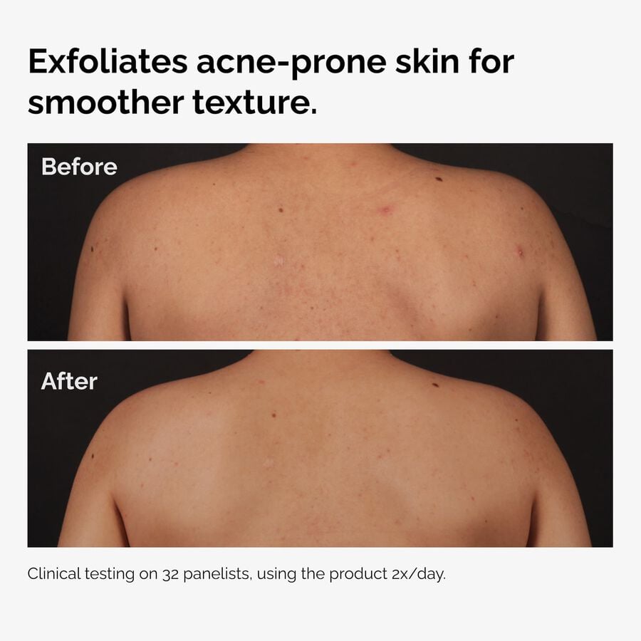the-body-care-collection-n6 ord-salicylic-acid-body-serum-before-after-graphic-NA.jpg